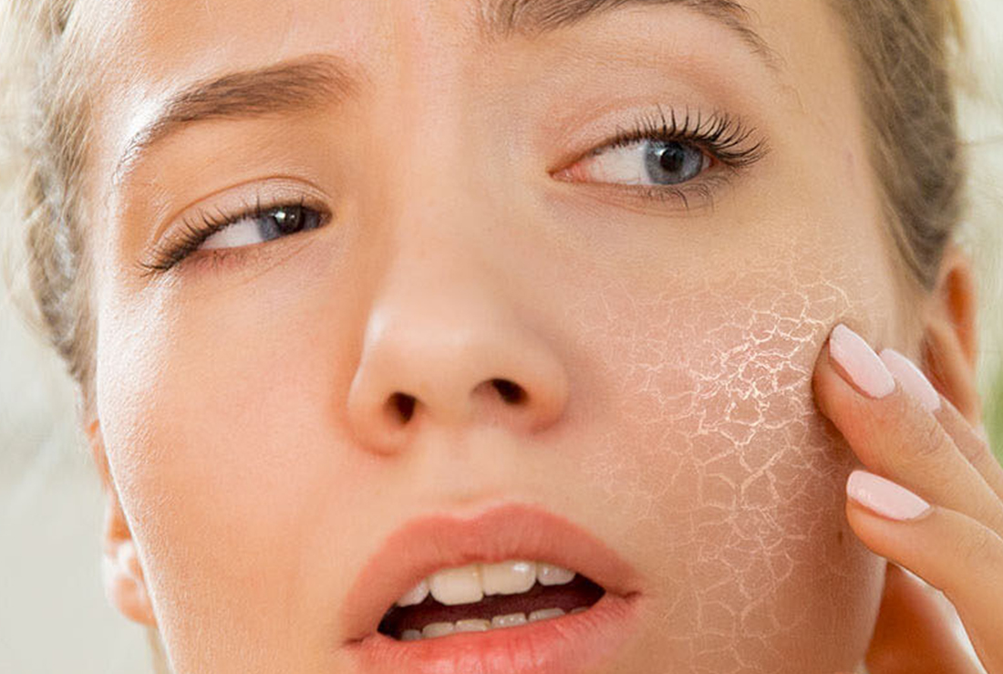 Лущиться шкіра на обличчі: який крем вибрати?